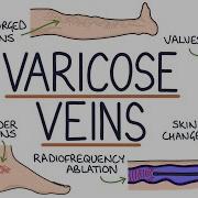 Vein