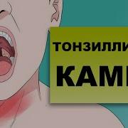 Тонзиллитные Камни Причины Образования