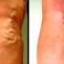 Madmaynemiller 7 Steps To Get Rid Of Varicose Veins Madmaynemiller
