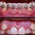 Braces Process