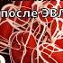 Видеолекция Прогнозирование профилактика и лечение ВТЭО после ЭВЛК 24 09 2021