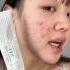 Is 345 Cream Worth It YesStyle Code GRACE888 To Get Off Skincare Kbeauty Acne