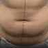 Male Abdomen Liposuction Same Day Result Fat Removal 4D Body Contouring Shortsfeed