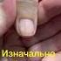 Меланома Дистрофия