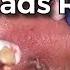 35 YEARS OLD DEEP BLACKHEAD REMOVAL BY DR LALIT KASANA NEW BLACKHEAD VIDEO