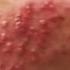 Burning Rash In The Chest