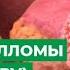 Вирус папилломы человека HPV Чем опасен вирус для женщины Как лечить