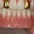 Process Denture With Gold Incisors Dental Smile Teeth Shorts Shortvideo Gold Dentures
