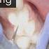 Teeth Sensitivity After A Cavity Filling What To Do