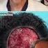 How Sculp Reduction Surgery Works Surgeon Reacts