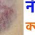 शर र पर न ल न श न क य पड ज त ह Why We See Blue Bruise In Our Body Gyan Ki Baatein