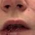 Woman Gets Surgery To Restore Lip Her Ex Boyfriend Bit Off