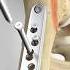 Femur Fracture Fixation Dynamic Hip Screw Method