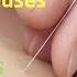 Natural Health Remedies Without Medicine Single Needle Treatment Pulse Balancing