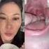 Dentist Reacts To Huge Juicy Tonsil Stones Tonsilstones