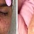 Clearing Teen Cystic Acne Facial Pimple Extractions MORE Jadeywadey180