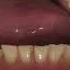 Повторное протезирование зубов коронки металлокерамика тотал ортопедическая стоматология