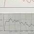 Uroflowmetry How To Interpret Flow Patterns