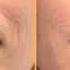 Get Rid Of NASOLABIAL FOLDS FAST SUBLIMINAL STRONG FORMULA