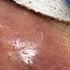Drainage Of An Infected Epidermal Cyst On The Face