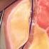 Laser Closure Of Fistula Tract FiLaC Video Credit SurgMedia Youtube Com