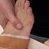 Foot Taping For An Avulsion Fracture Tim Keeley Physio REHAB