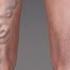 What Are Varicose Veins