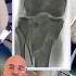 Challenging Fix For A Shattered Knee Shorts
