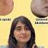 Skincare For Pigmentation And Uneven Skintone Sunscreen For Pigmented Skin Dark Spots Melasma