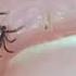 Medical Professionals Advise Against Going To E R For Tick Bites This