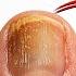 BEST Toenail Fungus Treatment 2024 4 BIG SECRETS