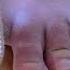 Turf Toe Treatment 1 Min Home Remedy