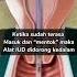 CARA MEMASUKAN KB IUD KEDALAM RAHIM KB SPIRAL DALAM RAHIM Kb Kbiud Tipskbiud Kbspiral