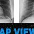 Chest Xray PA Vs AP View