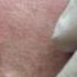 Radio Frequency Mole Removal Dr James Dickie