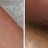 Wart Removal