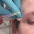 How Does The Botox Process Work Botoks Botox