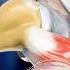 Surgeons Use Balloons To Fix Shoulder Pain Fast