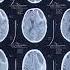 Acute On Chronic Subdural Hemorrhage Medico Ctscan Sdh Ich Crescent