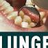 Amalgam Fillings A Creeping Health Risk The Guide