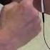 Stroke Rehabilitation Use Of Electrical Stimulation To Help Arm And Hand Recovery