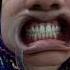 Rashid Dental Clinic Scaling Polishing Bleaching Braces Crown Rct Extraction Denture