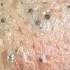 Blackheads Removal Full Video By Dr Lalit Kasana