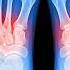 The Foot Specialist Your Toes Can Predict If You Ll Die Early This Will Fix Plantar Fasciitis