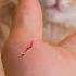 CAT SCRATCH DISEASE BARTONELLA HENSELAE Causes Symptoms Treatment Prevention Pathology