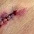 Removal Of A Superficial Epidermal Cysts