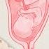 Placenta Previa Can You Still Have A Natural Birth