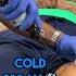 Knee Joint Aspiration Osteoarthritis Of The Knee