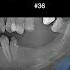 45 47 35 36 37 Mn Thin Ridge Case With Thin Gingiva In Consideration Of Zero Bone Loss Concept