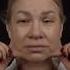 Extended Deep Plane Facelift Височный лифтинг Верх блефаро Док ФРОЛОВ